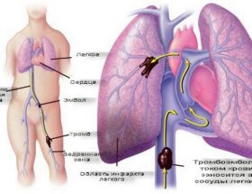 Інфаркт легені: провокуючі фактори, клінічні прояви, методи обстеження та лікування