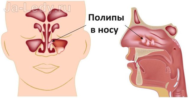 Як позбутися від закладеності носа без нежитю: причини і лікування закладеності носа