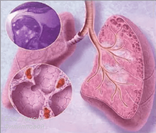 Саркоїдоз легенів: механізм розвитку, клінічні прояви, методи обстеження та лікування