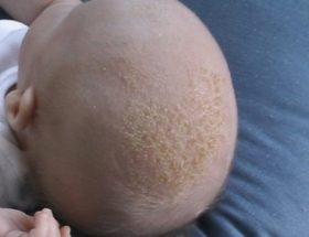Себорейний дерматит у немовляти: як правильно знімати скоринки у дитини