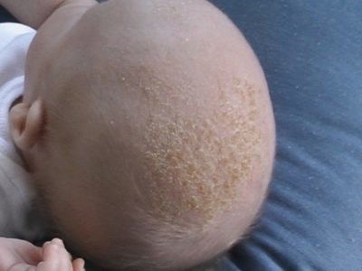 Себорейний дерматит у немовляти: як правильно знімати скоринки у дитини