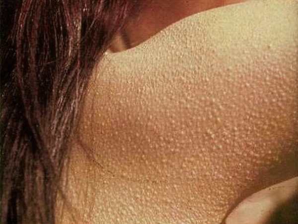Фолікулярний гіперкератоз: лікування, причини гусячої шкіри, як позбутися від гусячої шкіри
