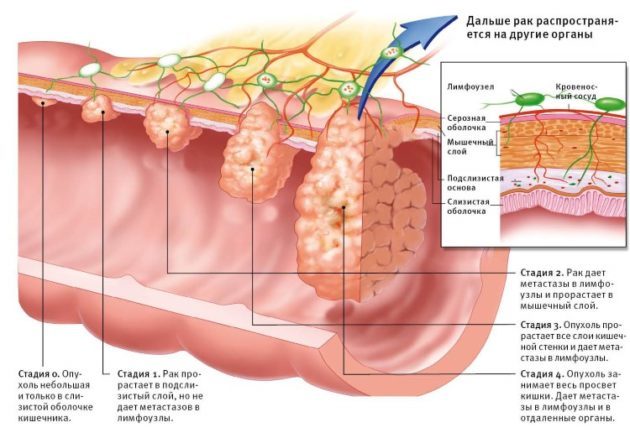 Доброякісні пухлини товстого кишечника: причини, симптоми, методи діагностики і лікування