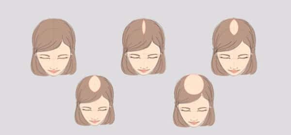 Чому випадає волосся у жінки в молодому віці