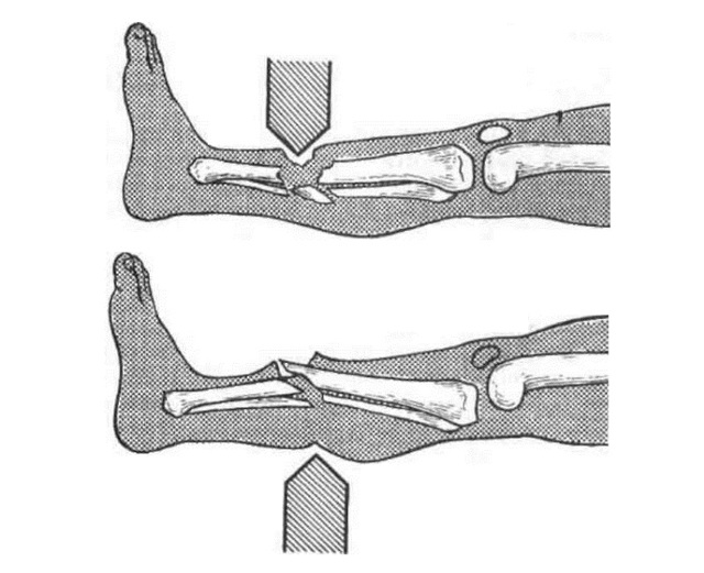 Перша допомога при переломах кісток: що робити при переломі відкритому чи закритому.