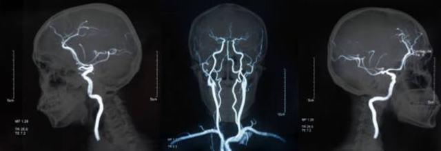 Аневризма судин головного мозку: симптоми, лікування, операції при аневризмі