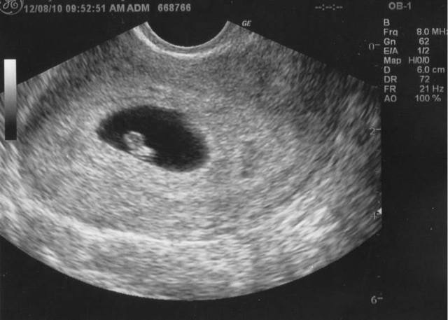 6 тиждень вагітності: що відбувається, узі, виділення, відчуття, плід на 6 тижні