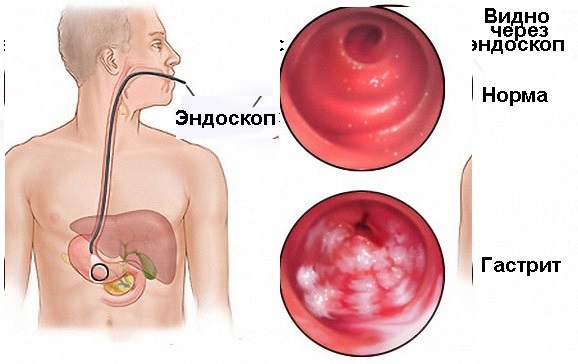 Гастрит з підвищеною кислотністю шлунка: симптоми, лікування медикаментами