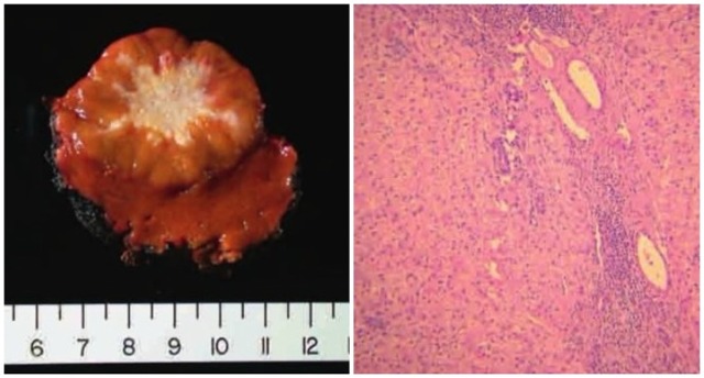 Нодулярна гіперплазія печінки: що це, симптоми і лікування, вогнищевий цироз на КТ і МРТ