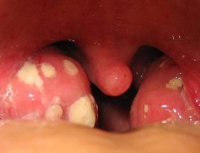 Як і чим лікувати стрептокок в горлі у дитини і дорослого?