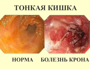Хвороба Крона: симптоми, лікування, діагностика хвороби Крона товстої кишки і тонкого кишечника.