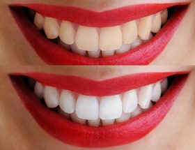 Як підготуватися до хімічного відбілювання зубів