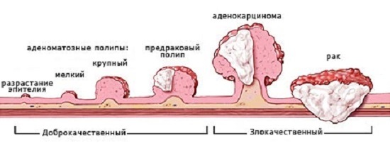 Псевдополіпоз ободової кишки: симптоми, лікування, ускладнення, прогноз