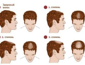Випадання волосся у чоловіків у молодому віці: причини і лікування облисіння