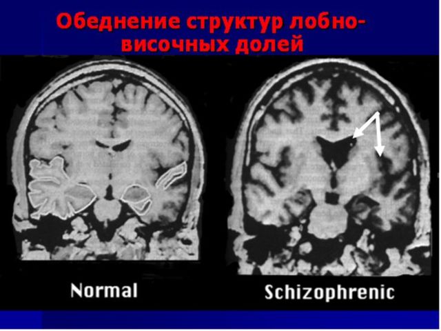 Шизофренія: ознаки і симптоми, основні причини шизофренії.