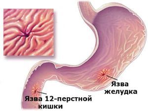 Канефрон - інструкція із застосування таблеток і крапель, аналоги Канефрона n