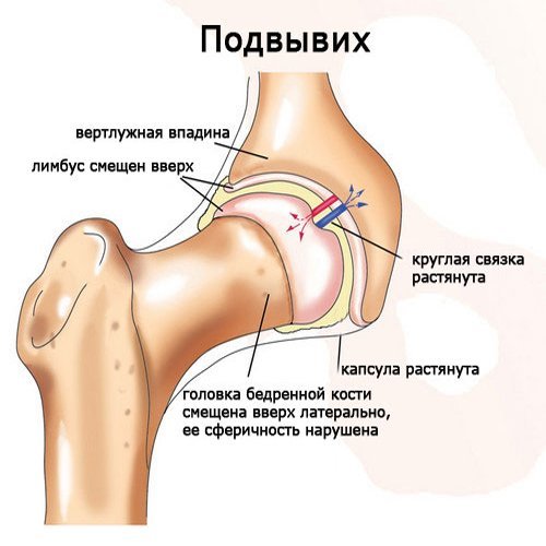 Дисплазія тазостегнових суглобів у дітей: симптоми, причини розвитку, лікування дисплазії ТБС, масаж і гімнастика при дисплазії тазостегнових суглобів  