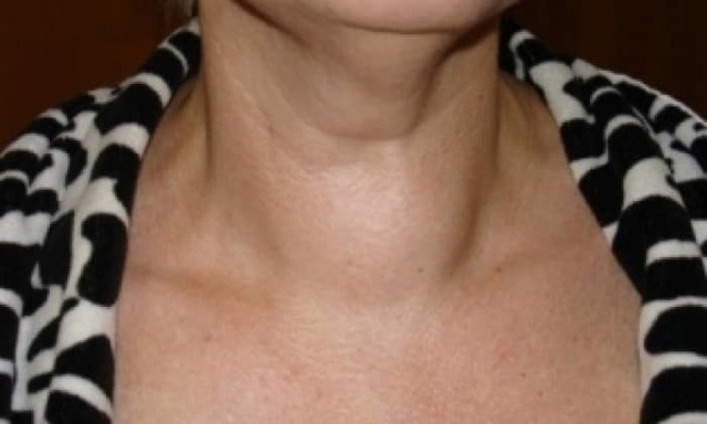 Кашель при щитовидці: симптоми і лікування, методи діагностики і профілактика