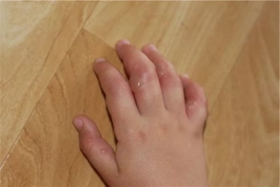 З'являються бульбашки на руках у дитини, що це таке?