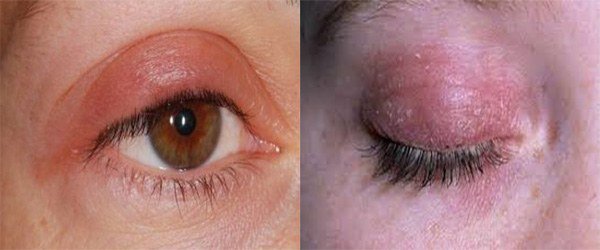 Алергія на нарощені вії: що робити, симптоми і лікування