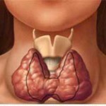 Рак щитовидної залози: симптоми і лікування, методи діагностики, фактори, що сприяють розвитку раку щитовидки, профілактика
