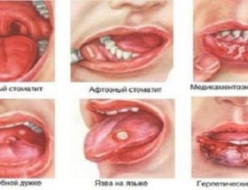 Алергічний стоматит: симптоми патології, методи лікування і докладні фото різних форм захворювання