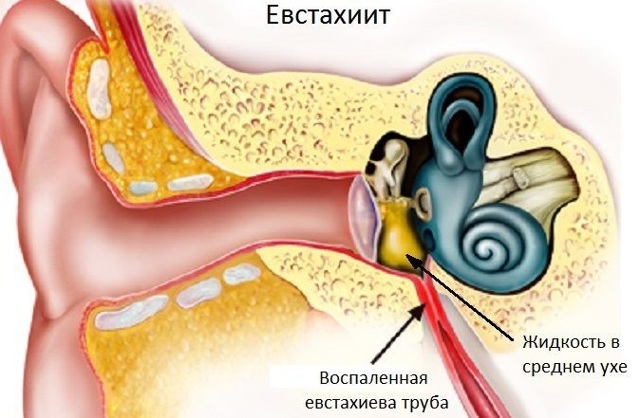 Євстахіїт: симптоми і лікування тубоотіта, ознаки хронічного і гострого евстахиита, як лікувати євстахіїт