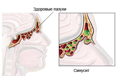 «Санорин»: інструкція із застосування крапель і спрею для дітей і дорослих, аналоги