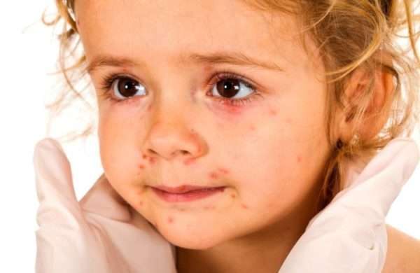 Вітрянка на оці у дитини: чим лікувати, лікування і симптоми