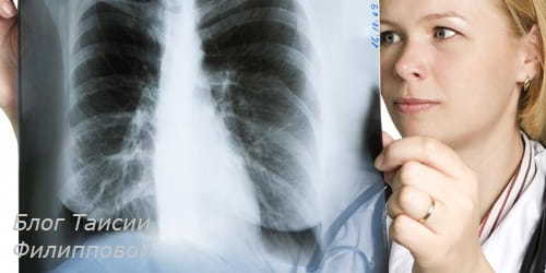 Саркоїдоз легенів: симптоми, лікування, причини та прогноз