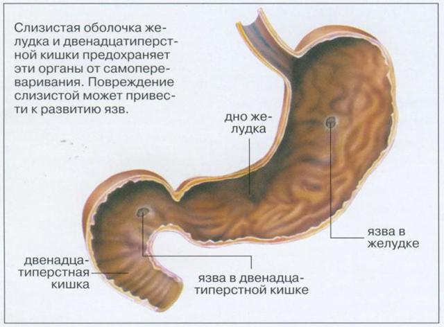 Виразка дванадцятипалої кишки (ulcus duodeni): як проявляється, методи лікування і які можливі ускладнення
