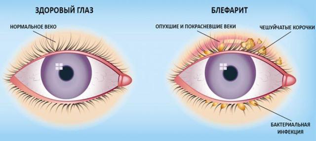 Знеболюючі очні краплі після травми очей, c протизапальний ефект, список препаратів