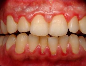 Набряк ясна біля зуба: причини запалення, методи лікування, застосування полоскань