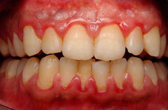 Набряк ясна біля зуба: причини запалення, методи лікування, застосування полоскань