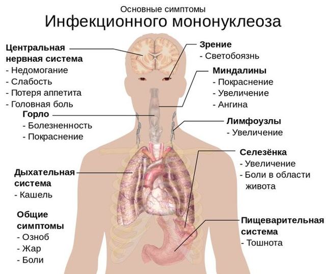 Інфекційний мононуклеоз: симптоми, діагностика, лікування інфекційного мононуклеозу і профілактика захворювання
