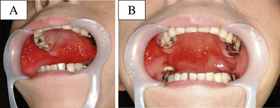 Алергія на зубний протез в стоматології, протез в порожнині рота: симптоми і лікування