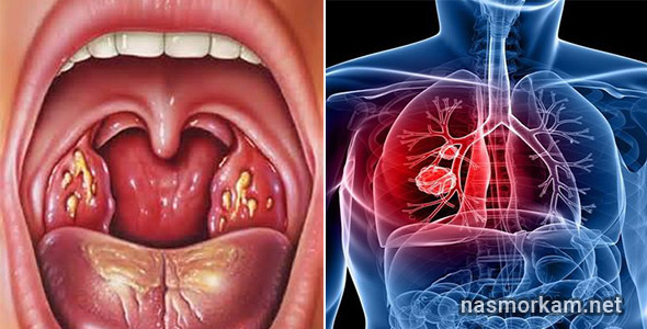 Болить горло в області трахеї, як вилікувати?