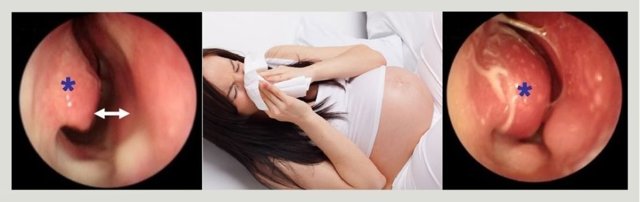 Вазомоторний риніт при вагітності: симптоми і лікування