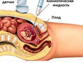 Амніоцентез при вагітності: значення дослідження, підготовка до аналізу, техніка проведення процедури