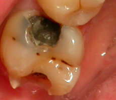Чому випадають пломби із зубів, що робити, якщо погано поставили пломбу