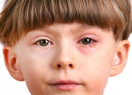 Алергія на очах: ​​як лікувати симптоми - набряк, почервоніння і свербіж