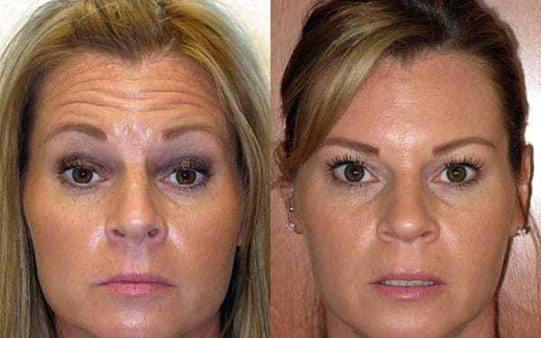 Ботокс для особи: фото до і після, протипоказання для уколів краси, побічний ефект