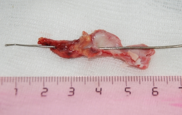 Операції при вроджених свищах і кістах шиї: опис і види
