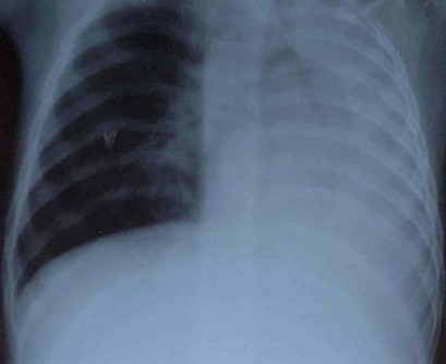 Ателектаз легенів: причини, симптоми, лікування, ателектаз легенів у дітей