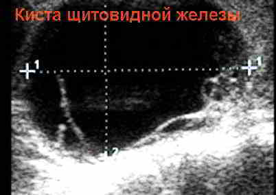 Вогнищеві утворення в щитовидній залозі правої і лівої частки