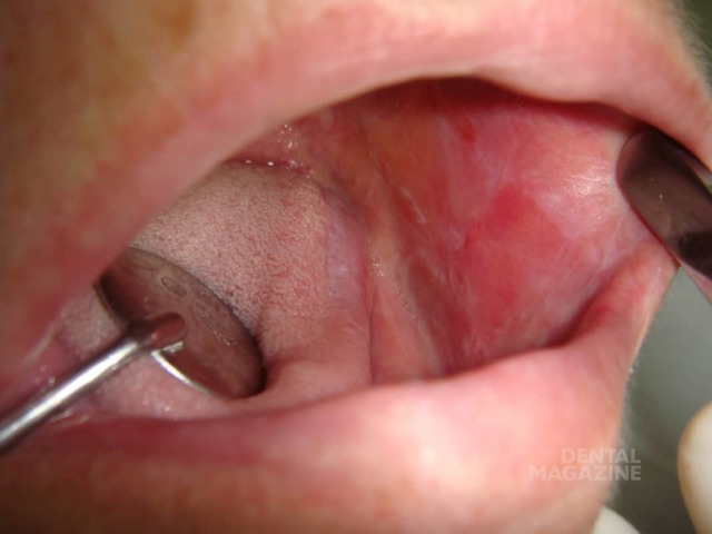 Червоний плоский лишай слизової рота і шкіри, симптоми і лікування