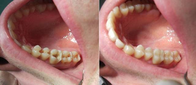 Які пломби краще ставити на жувальні і передні зуби: порівняння пластмасових і светоотверждаємих пдломб