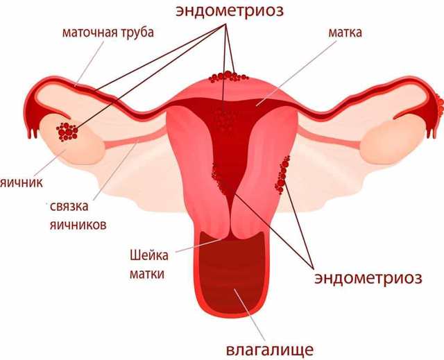 Викорінення матки: показання до операції і відновлення