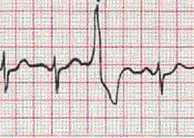 Симптоми екстрасистолії і ЕКГ-ознаки порушення ритму серця