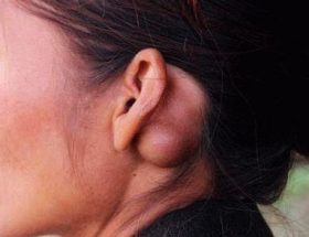 Ліпома вуха: фактори ризику розвитку, типові симптоми, способи лікування та можливі ускладнення